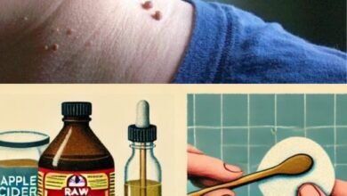 How to Remove Skin Tags Naturally at Home with Apple Cider Vinegar