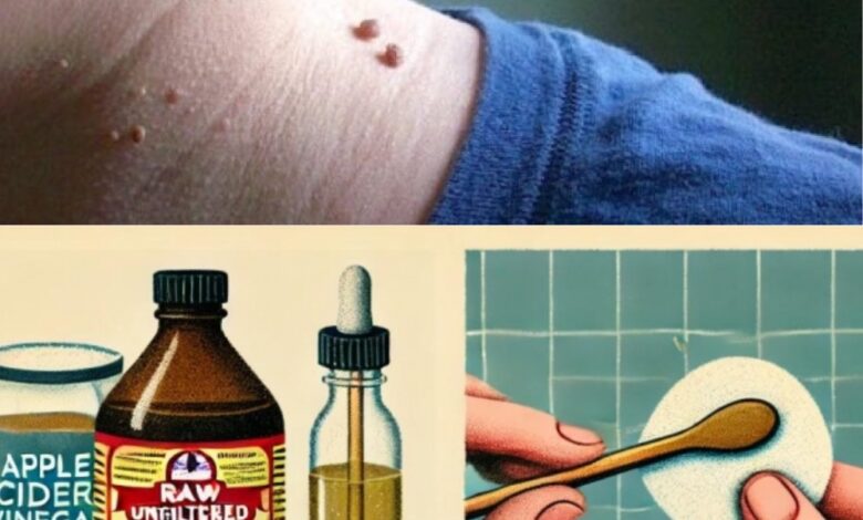 How to Remove Skin Tags Naturally at Home with Apple Cider Vinegar